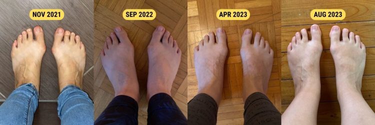 A Year In Barefoot Shoes: The Astonishing Before And After Results ...